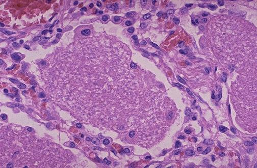 Patogenia Paso crítico para establecer la enfermedad: Unión del P jiroveci a la célula epitelial pulmonar a través del β glucano Proliferación del organismo.