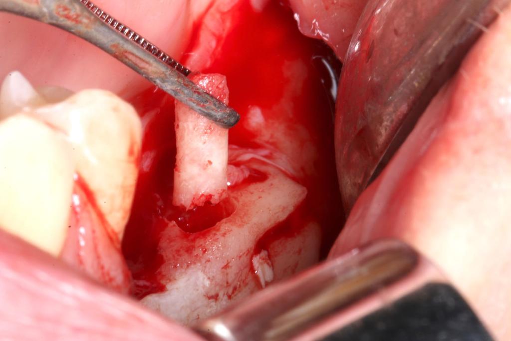 Cirugías en directo Día 4 Realización de dos cirugías reconstructivas en directo DL Cirugía Oral Exposición y análisis de los casos a operar Análisis Clínico de los casos de Cirugía reconstructiva: