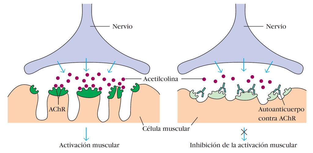 Miastemia Grave Auto-anticuerpos Bloqueantes Funcionamiento Normal Nervio Miastemia Grave Nervio Acetilcolina AChR (Receptores de Acetilcolina)