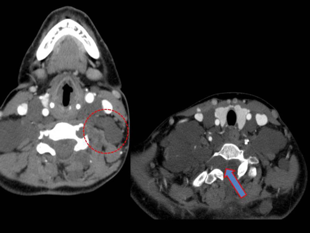 Fig. 9: NEUROFIBROMAS PLEXIFORMES: TC de cuello con CIV plano axial: múltiples lesiones hipodensas sin realce al contraste (
