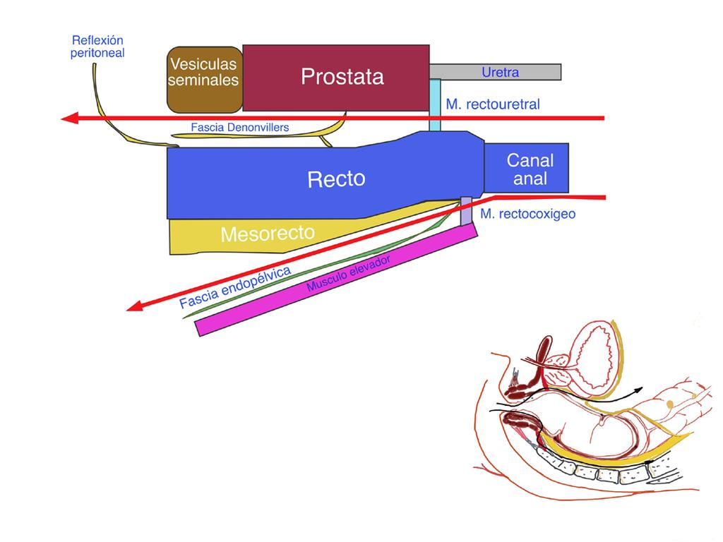 Apertura de la reflexión peritoneal Una vez pasada la disección de las vesículas seminales se reconoce el peritoneo que tras su apertura conecta con el abdomen, siendo este el momento de igualar las