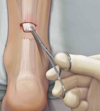 La guía moldeada anatómicamente no es descartable; el material de sutura y las agujas se ofrecen empaquetados en un práctico kit.