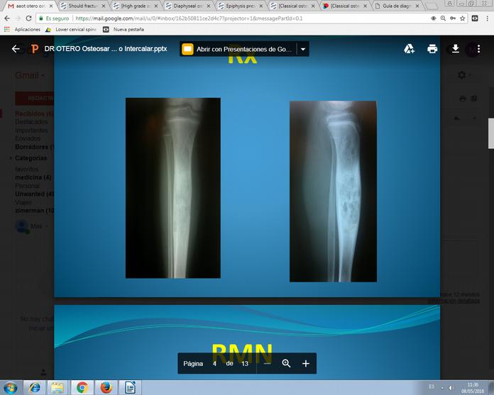 Figura 2. Radiografía de pierna, de perfil. Diagnóstico presuntivo En paciente en edad pediátrica con clínica y radiografiá concordante se establece como primer diagnostico osteosarcoma.