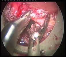 Se inicia la resección punteando una línea con el bisturí eléctrico monopolar a 5-10 mm de la tumoración.