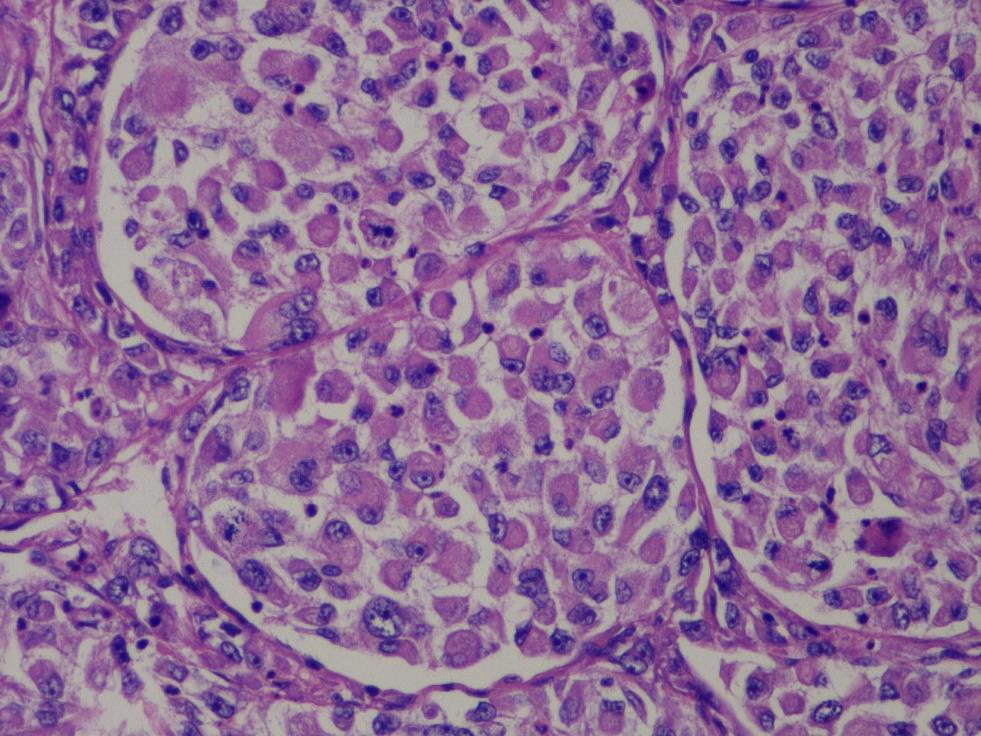 Sarcomas de células epitelioides S. epitelioide T. rabdoide maligno Fibrosarcoma epitelioide esclerosante S. células claras S. alveolar de partes blandas T.