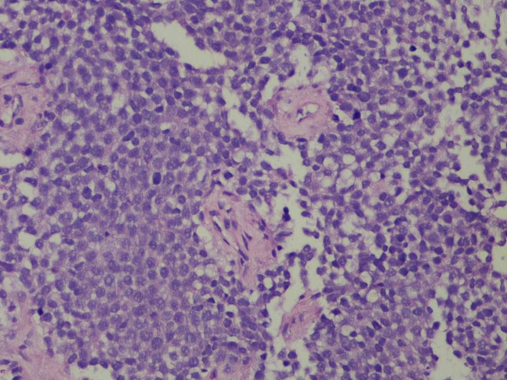 Sarcomas de células redondas S. Ewing S. Ewing-like Neuroblastoma Rabdomiosarcoma embrionario /alveolar T. desmoplásico de células redondas S.