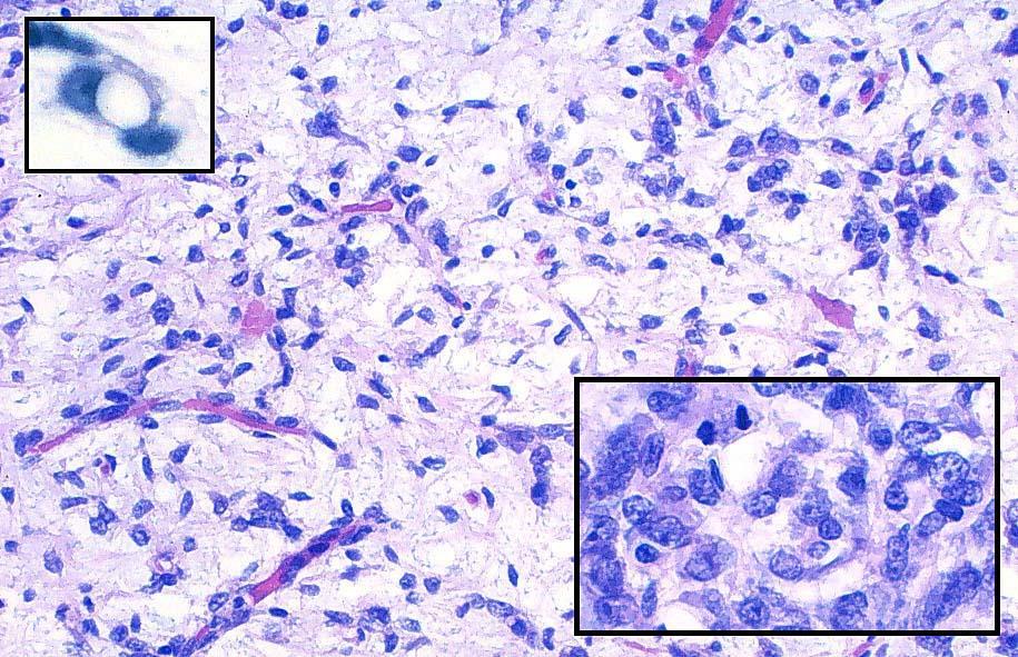 Liposarcoma de células redondas (mixoide poco diferenciado) Con células redondas primitivas, menor