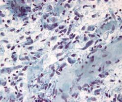 Limitaciones de la PAAF en tumores de partes blandas: Fascitis nodular Diagnóstico diferencial