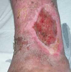 Lesiones cutáneas SECUNDARIAS Ulcera: lesión deprimida