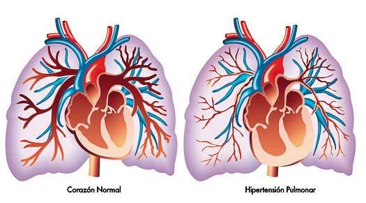 Definición Presión pulmonar media 25 mmhg registrados
