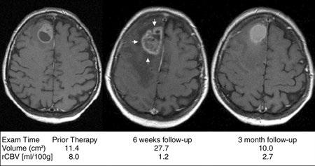 Assessment of Brain Metastases with Dynamic Susceptibility-weighted Contrast-enhanced MR Imaging: Initial
