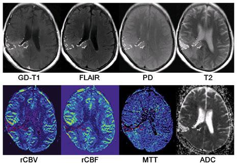 learning using multiparametric MRI features may be a promising approach to identify the