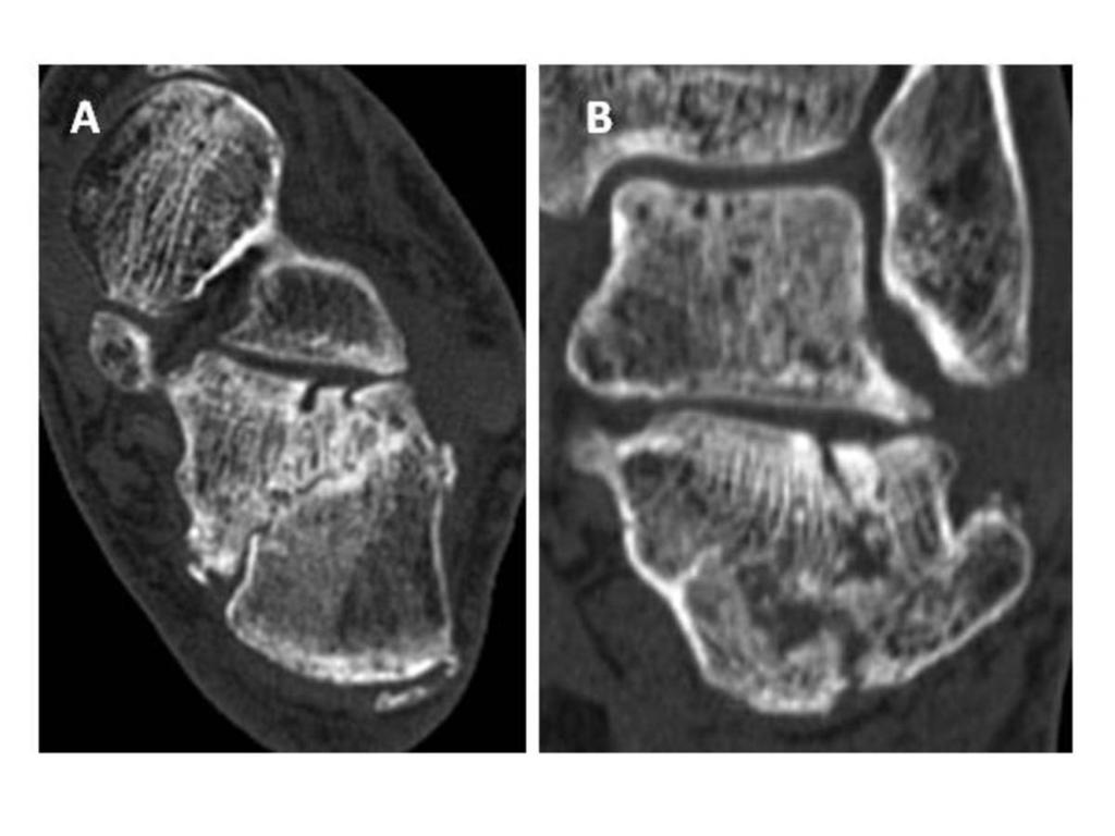 Fig. 8: Fractura intraarticular tipo I c de Sanders. Imagen axial (A) y coronal (B).