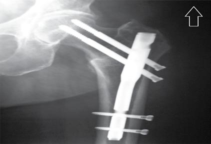 Vargas Ortiz PD y col. Clavo centromedular vs. tornillo dinámico de cadera consolidación de la fractura y la pronta deambulación del paciente.