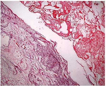 Figura 4 Fotografía panorámica de placa de ameloblastoma uniquístico de patrón arquitectónico plexiforme negativo para la inmunotinción con Ki-67 70 Figura 2 Fotografía de placa con tinción de