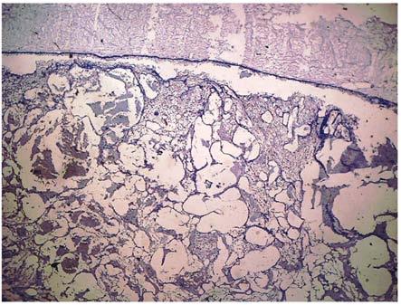 hematoxilina-eosina Figura 3 Fotografía de placa de ameloblastoma uniquístico de patrón arquitectónico intramural teñido con hematoxilina-eosina De las 10 placas con diagnóstico de ameloblastoma