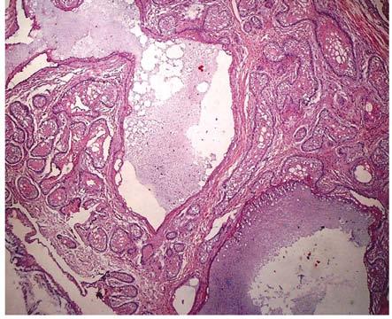 sólido de patrón folicular y plexiforme; una, como ameloblastoma sólido folicular y acantomatoso, y una, como ameloblastoma de patrón plexiforme.