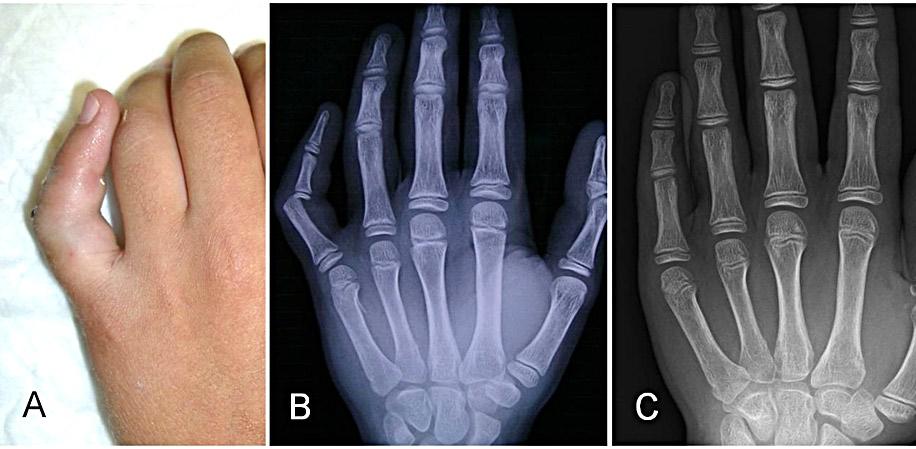 Luxaciones de los dedos de la mano en niños y adolescentes Figura 3. A: Luxación IFP del meñique. B: Radiografías iniciales. C: Reducción cerrada.