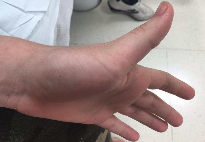 MATERIAL Y MÉTODOS Presentamos una adolescente de 14 años, que acude a urgencias por dolor y deformidad del primer dedo de la mano derecha, tras sufrir un traumatismo mientras