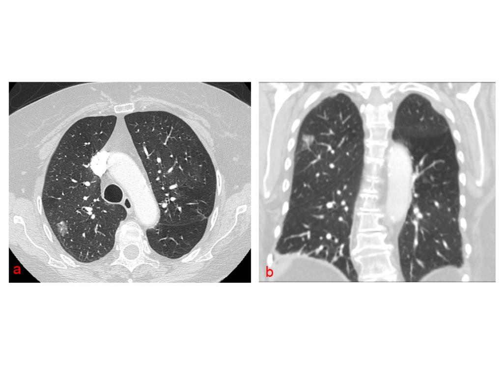 Fig. 3: Imágenes de TC en axial y coronal de un adenocarcinoma pulmonar in situ.