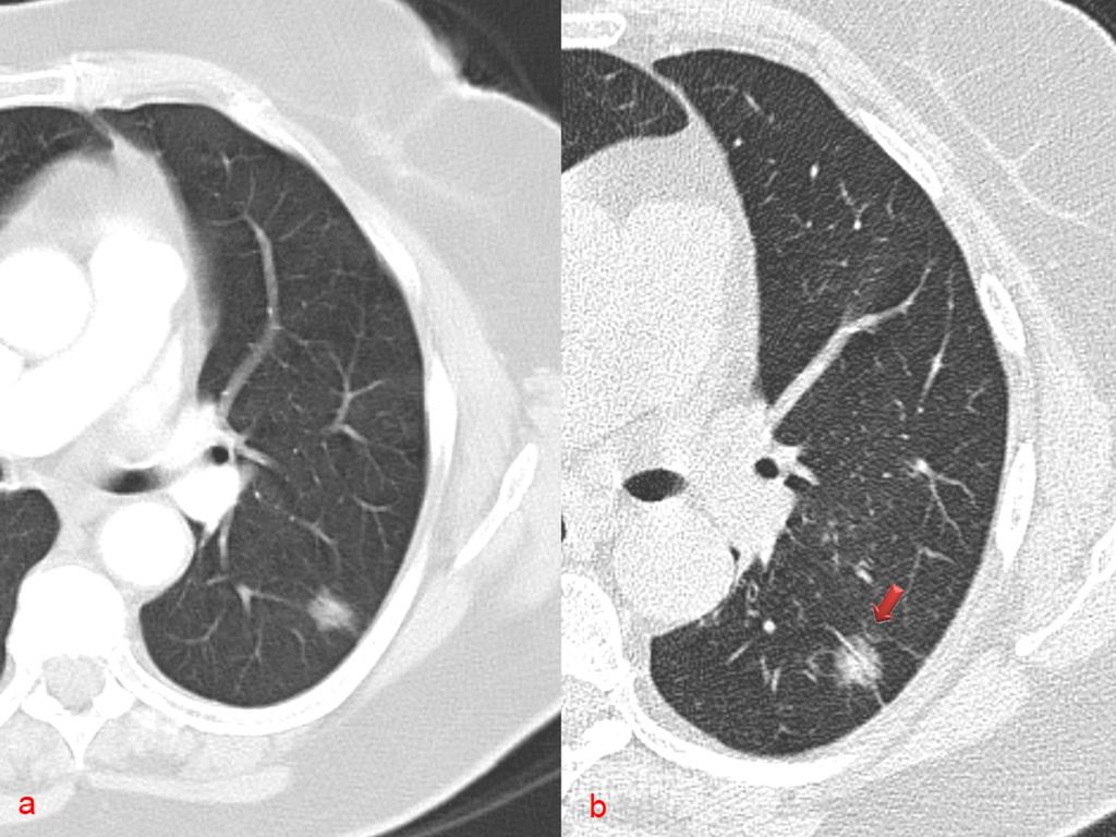 Fig. 4: TC torácico en mujer de 74 años. a) Nódulo en vídreo deslustrado de 1,2 mm que probablemente correpondia adenocarcinoma in situ o minimamente invasivo.