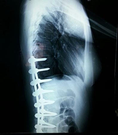 Figura 3: Radiografía lateral post-quirúrgica.