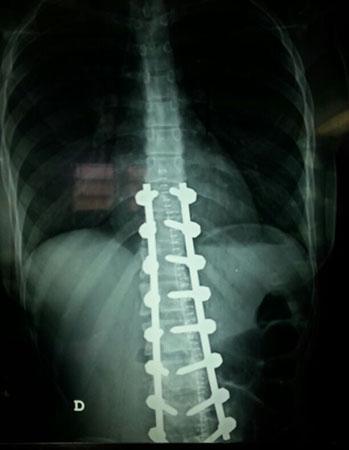 vertebral dorso lumbar Figura 4: Radiograía posteroanterior