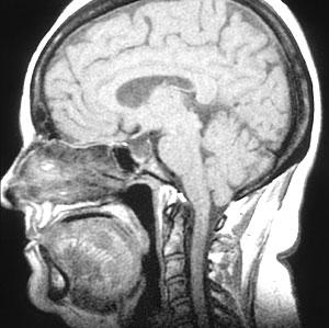 HIPERTENSION INTRACRANEAL SIGNOS-SINTOMAS Alteraciones visuales Cefalea Vómitos