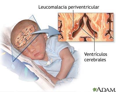 LPV : Ubicación Angulo externo de los cuernos anteriores de los ventriculos laterales cerca del