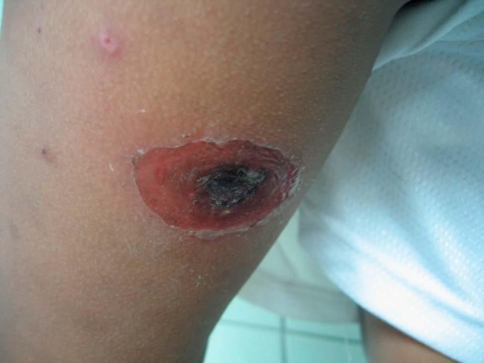 Impétigo % de los pacientes con dermatitis atópica tienen colonizada la piel eczematosa con Staphylococcus áureus.
