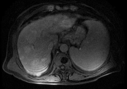 T2 Arterial DWI Portal FHC FHC Hígado cirrótico donde se aprecia lesión de nueva aparición en segmento VI.