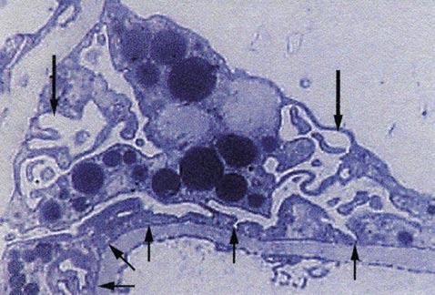 E. Fernández Ruiz F M C 181 FIGURA 5. Ovillo glomerular FIGURA 6. Podocito dismórfico El ovillo glomerular contiene exceso de matriz con muy pocas células (teñida en azul).