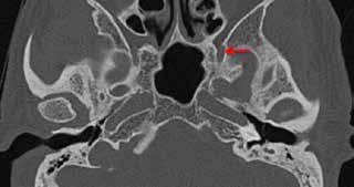 3a 5 3b Figura 5: Corte axial de tomografía computada en base de cráneo, en orden descendente se indica el canal vidiano(1), foramen oval(2), foramen espinoso(3) y canal carotídeo(4).