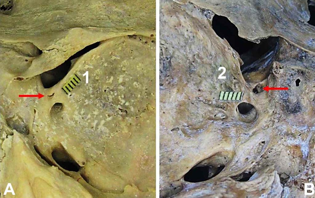 MATERIAL Y MÉTODO Se analizaron 276 órbitas provenientes de 138 cráneos secos de individuos adultos chilenos de ambos sexos en búsqueda de FVOC.