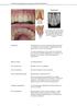 Traumatismo en las estructuras de soporte del diente sin incremento de la movilidad o desplazamiento del diente pero con dolor a la percusión.
