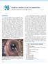 Cirugía de cataratas en ojos con megalocórnea
