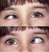 Parálisis del motor ocular externo en Pediatría