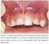 Tratamiento conservador en dientes temporales y permanentes jóvenes.
