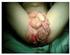 Tratamiento de condilomas acuminados gigantes de la vulva. combinando láser CO 2