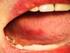 Cáncer de la mucosa oral (continuación)