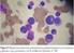 Prevalencia de plaquetopenia en niños infectados con el virus de la inmunodeficiencia humana en un Centro de Referencia