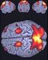 técnicas de neuroimagen y funcionales como la resonancia magnética (RM) con sus variantes o la tomografía por emisión de positrones (PET).