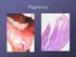 3. Los patrones de diseminación linfática de los tumores de cabeza y cuello.