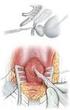 Reparación de estenosis uretral postraumática con injerto de mucosa bucal. Repair of the post-traumatic urethral stenosis with buccal mucosa Graft