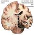 Dos casos de atrofia cortical posterior, la demencia que inicia con síntomas visuales.