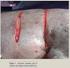 Colgajos pediculados en defectos de tejidos blandos en niños