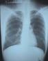 Supervivencia en pacientes con neumonía intersticial usual en contexto de fibrosis pulmonar idiopática y enfermedad del tejido conectivo