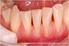Hiperestesia Dentinaria. Su tratamiento.