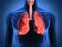 6. Trasplante pulmonar