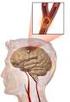 Enfermedad Vascular Cerebral Isquémica en menores de 45 años (Cerebral Infarction in people under 45 years)